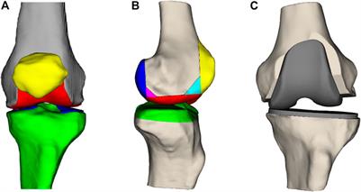 Artificial Intelligence Based Patient-Specific Preoperative Planning Algorithm for Total Knee Arthroplasty